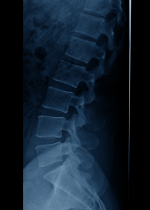 Radiologie Poissy colonne vertébrale dos